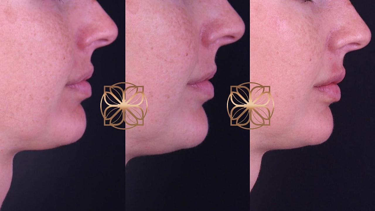 Injectables Gallery Before & After