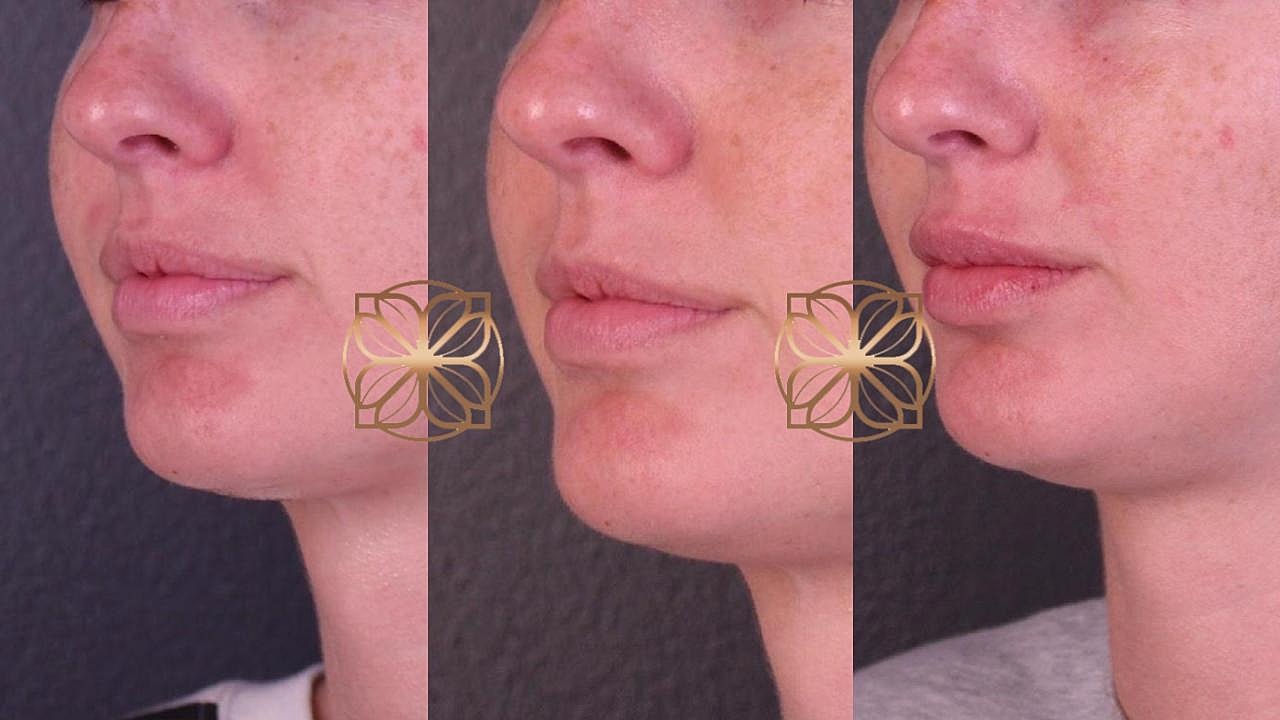 Injectables Gallery Before & After