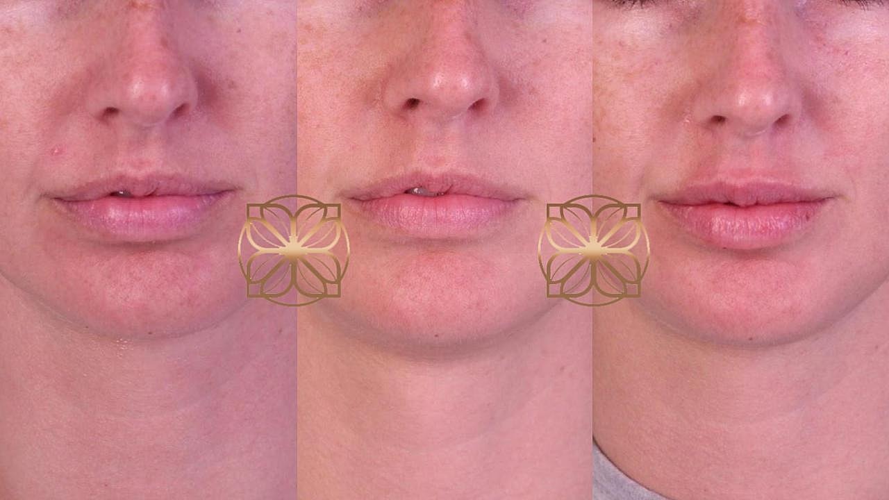 Injectables Gallery Before & After