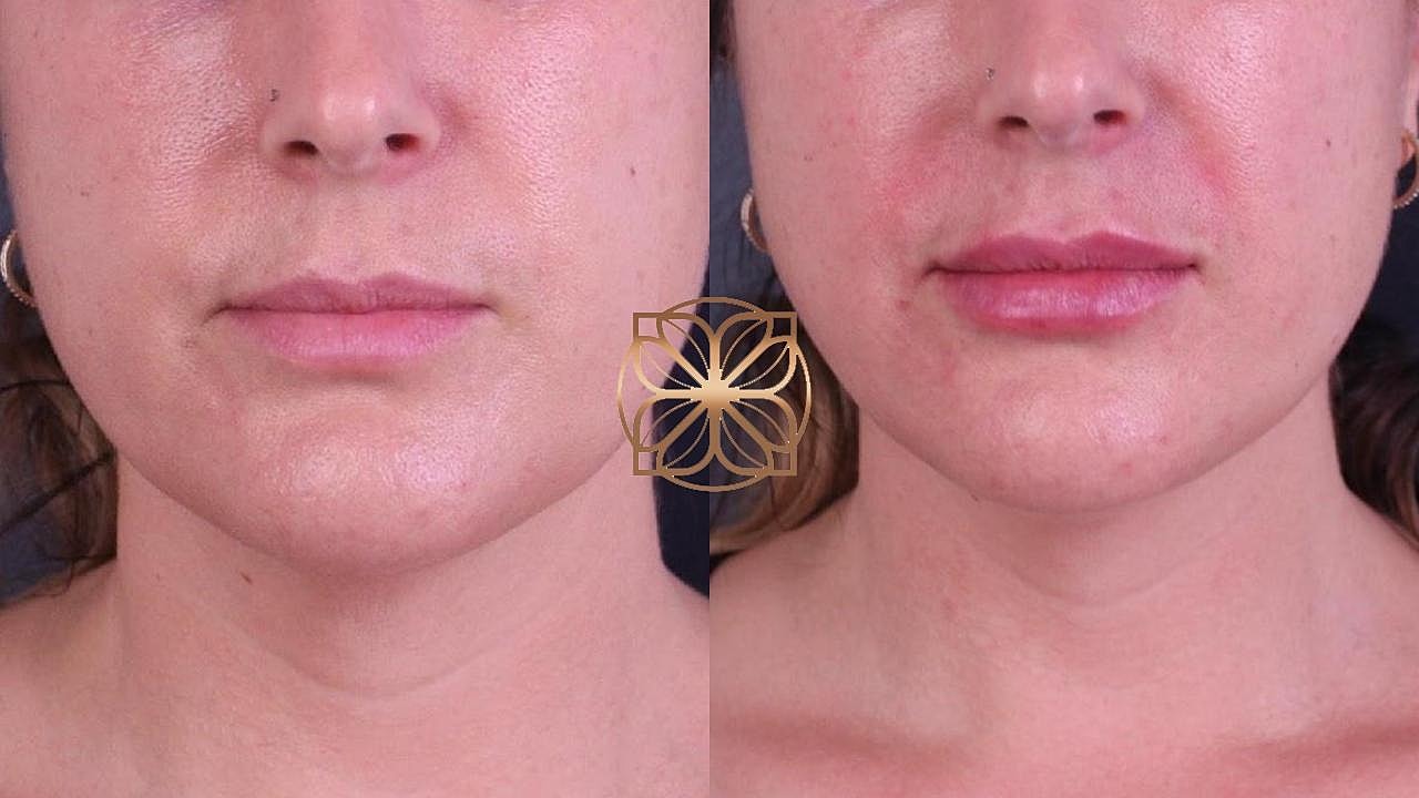 Injectables Gallery Before & After