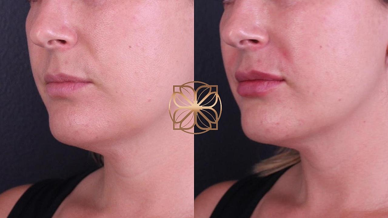 Injectables Gallery Before & After