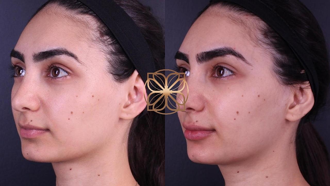 Injectables Gallery Before & After