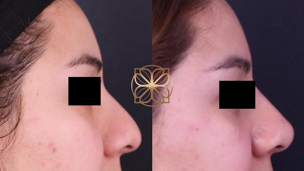 Injectables Gallery Before & After
