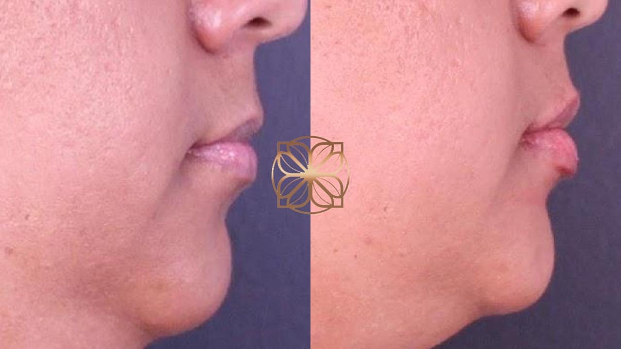 Injectables Gallery Before & After