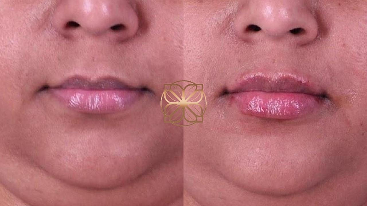 Injectables Gallery Before & After