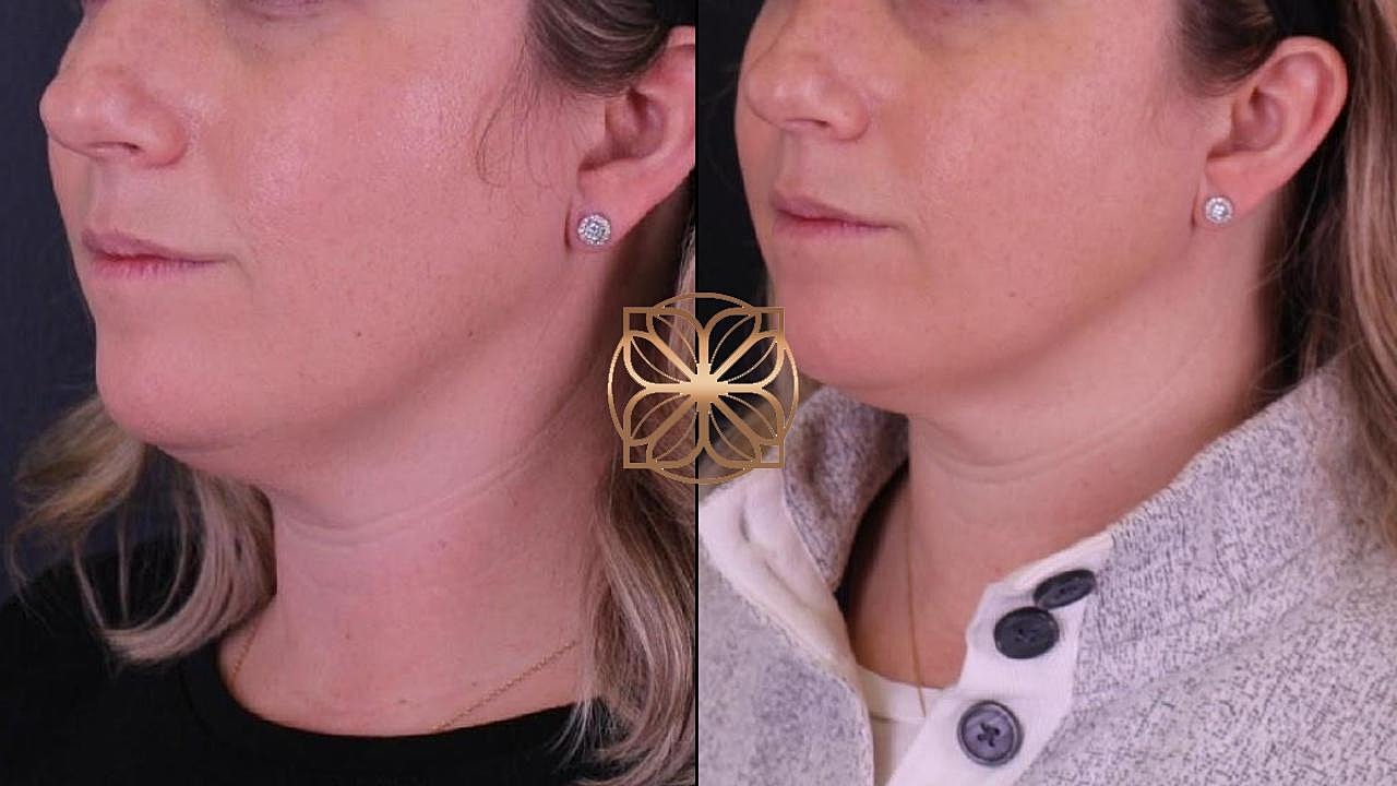 Injectables Gallery Before & After