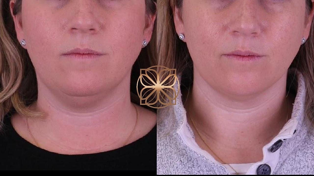 Injectables Gallery Before & After