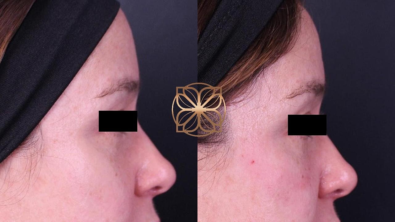 Injectables Gallery Before & After