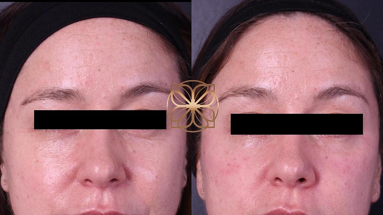 Injectables Gallery Before & After