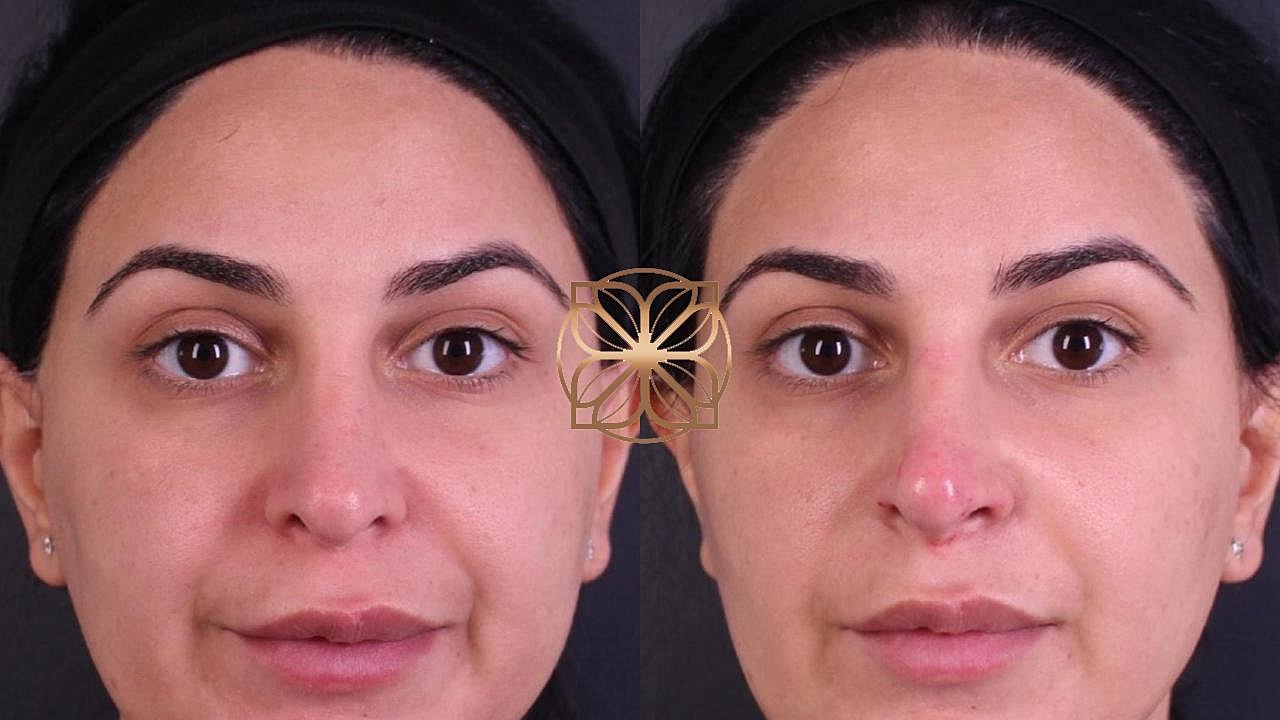 Injectables Gallery Before & After