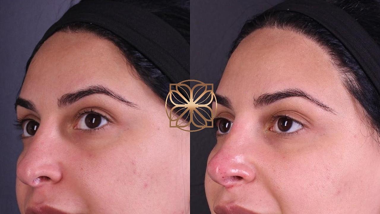 Injectables Gallery Before & After