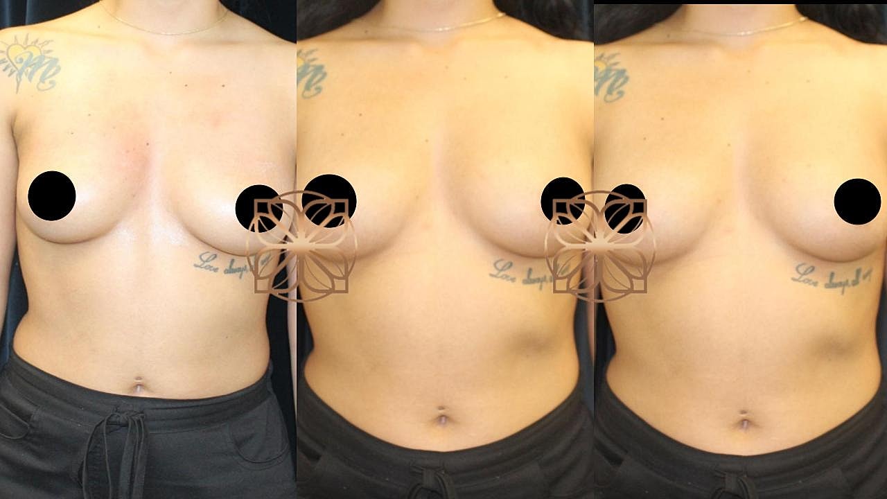 Injectables Gallery Before & After