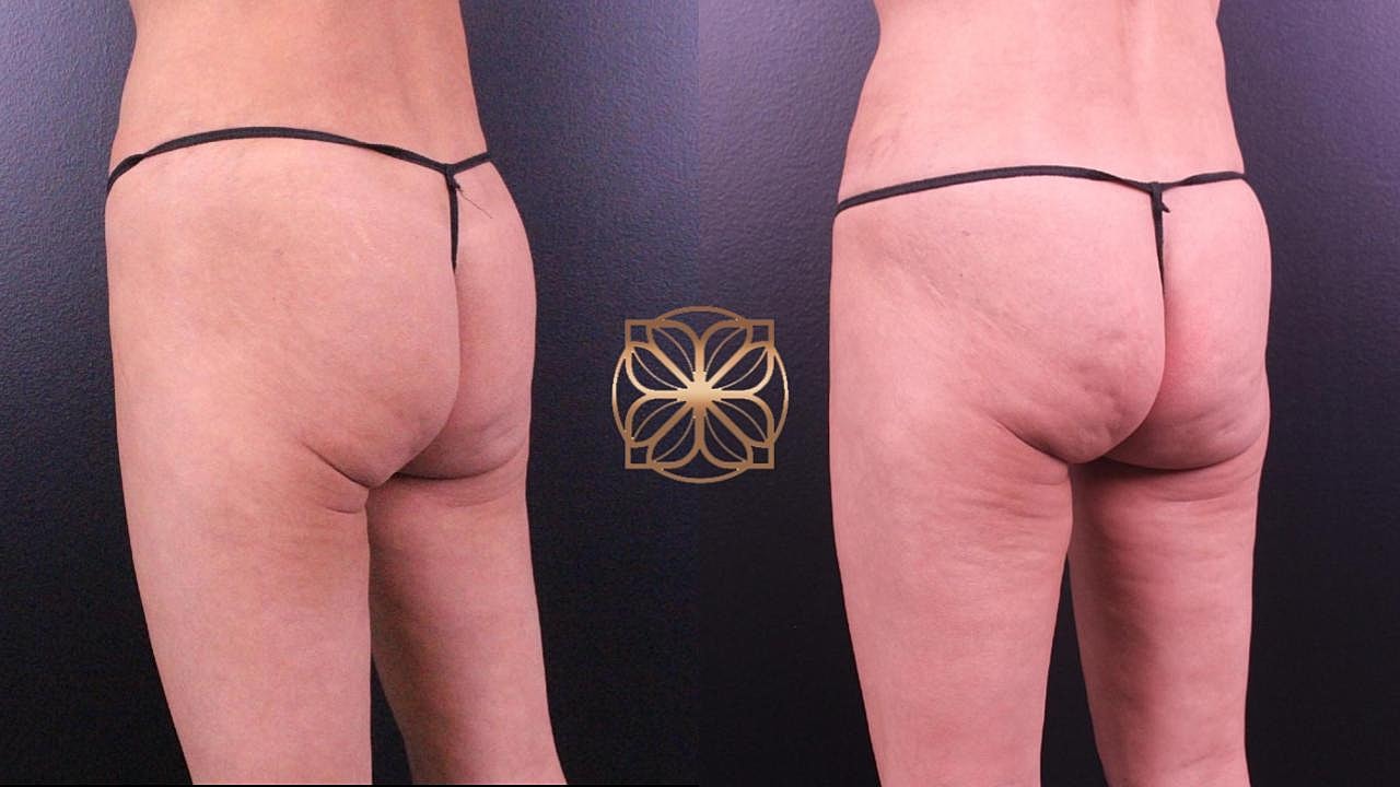 Injectables Gallery Before & After