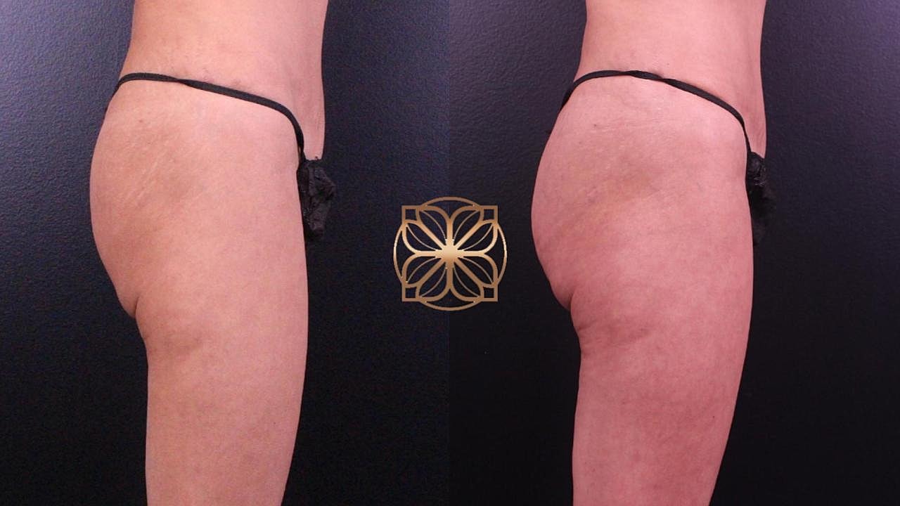 Injectables Gallery Before & After