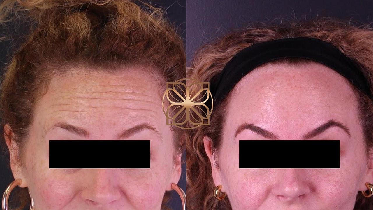 Injectables Gallery Before & After