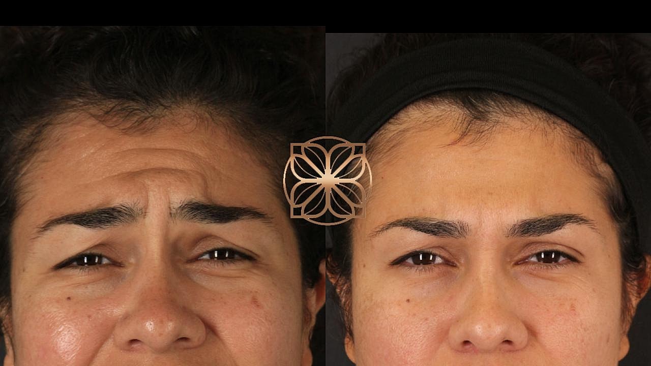 Injectables Gallery Before & After