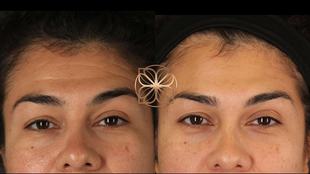 Injectables Gallery Before & After