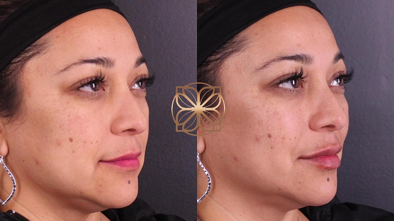 Injectables Gallery Before & After