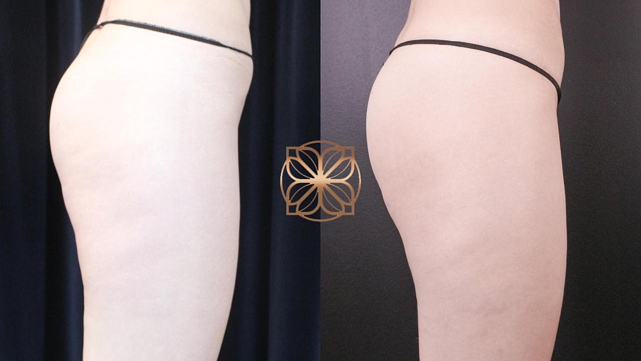 Injectables Gallery Before & After