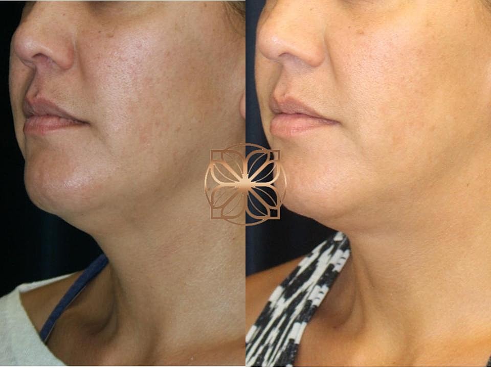 Injectables Gallery Before & After