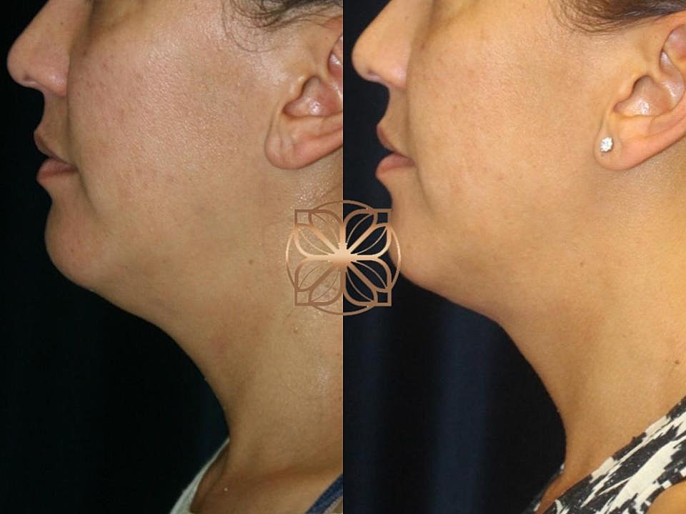 Injectables Gallery Before & After