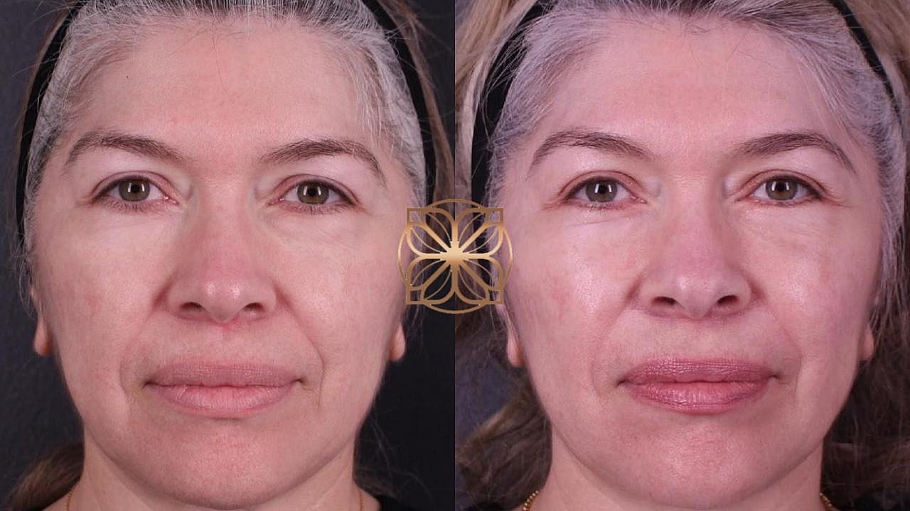 Injectables Gallery Before & After
