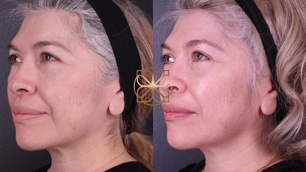 Injectables Gallery Before & After