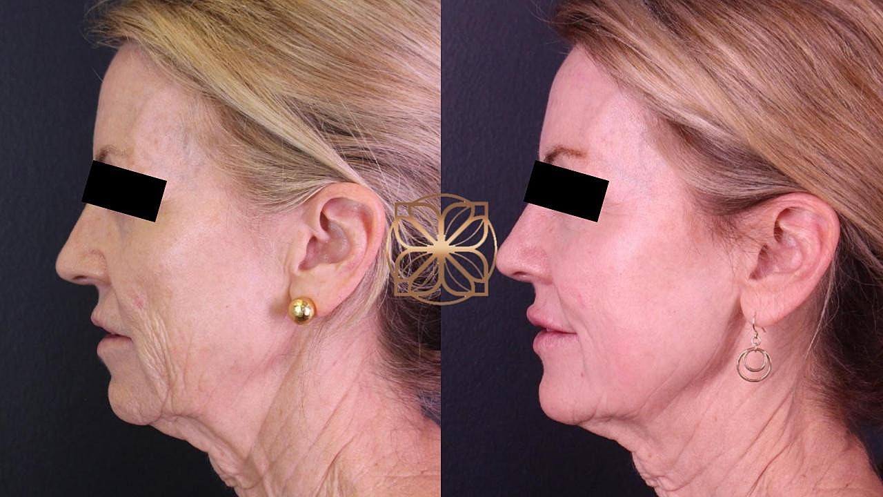 Injectables Gallery Before & After