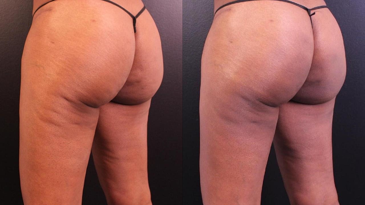 Injectables Gallery Before & After