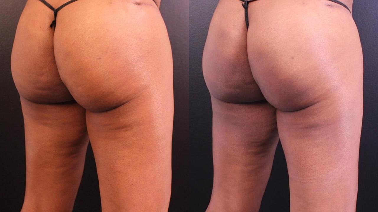 Injectables Gallery Before & After