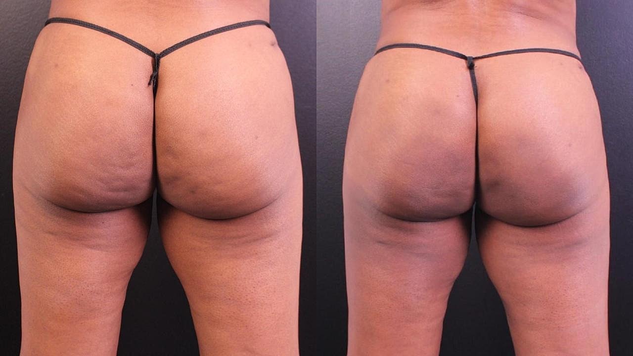 Injectables Gallery Before & After