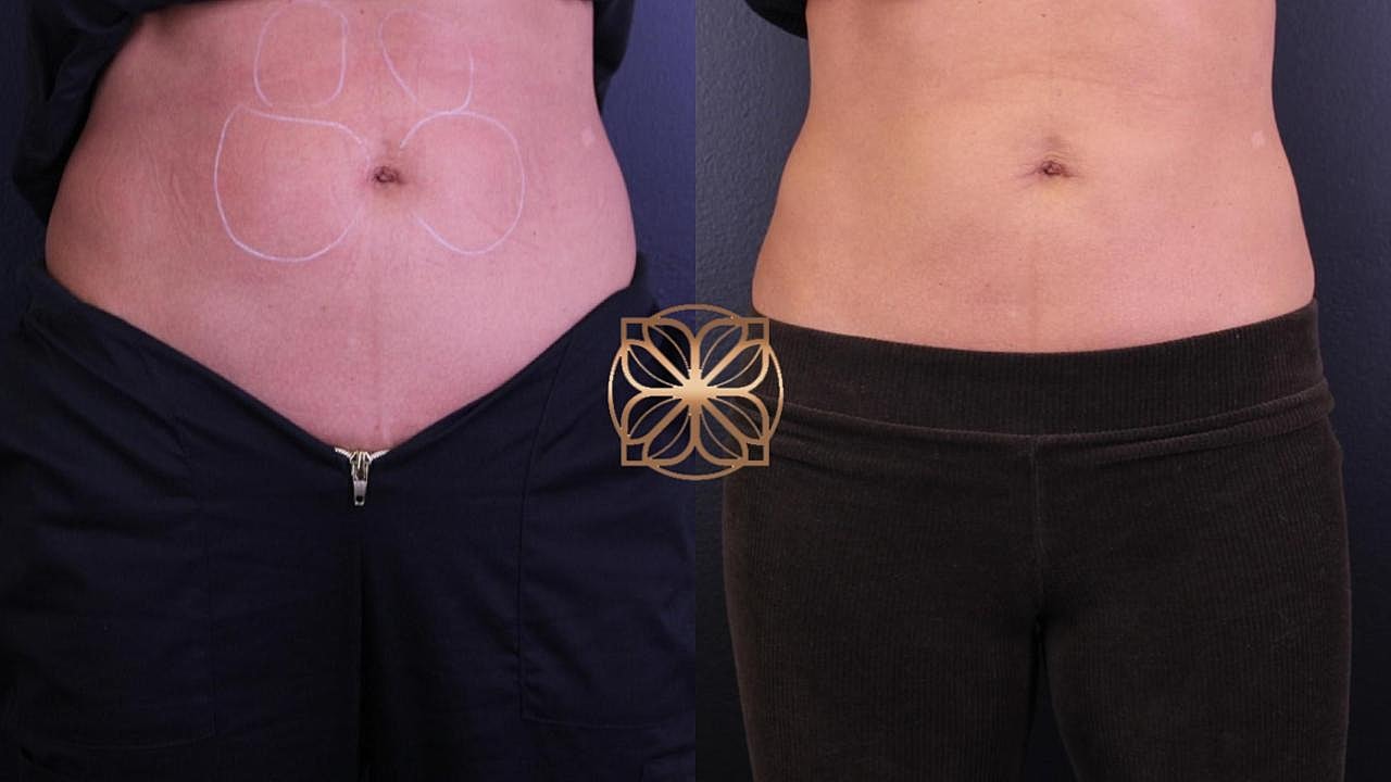 Injectables Gallery Before & After