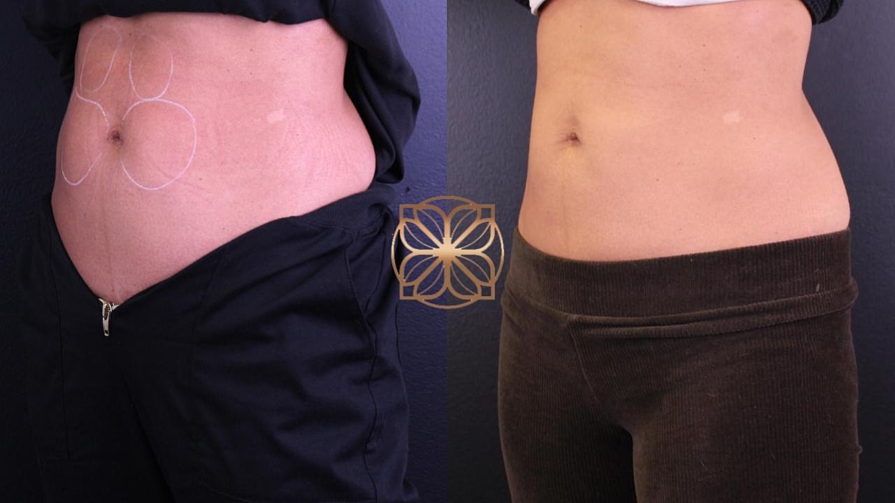 Injectables Gallery Before & After