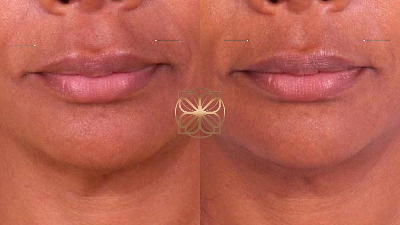 Injectables Gallery Before & After