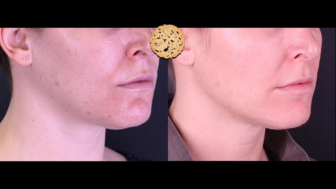 Injectables Gallery Before & After