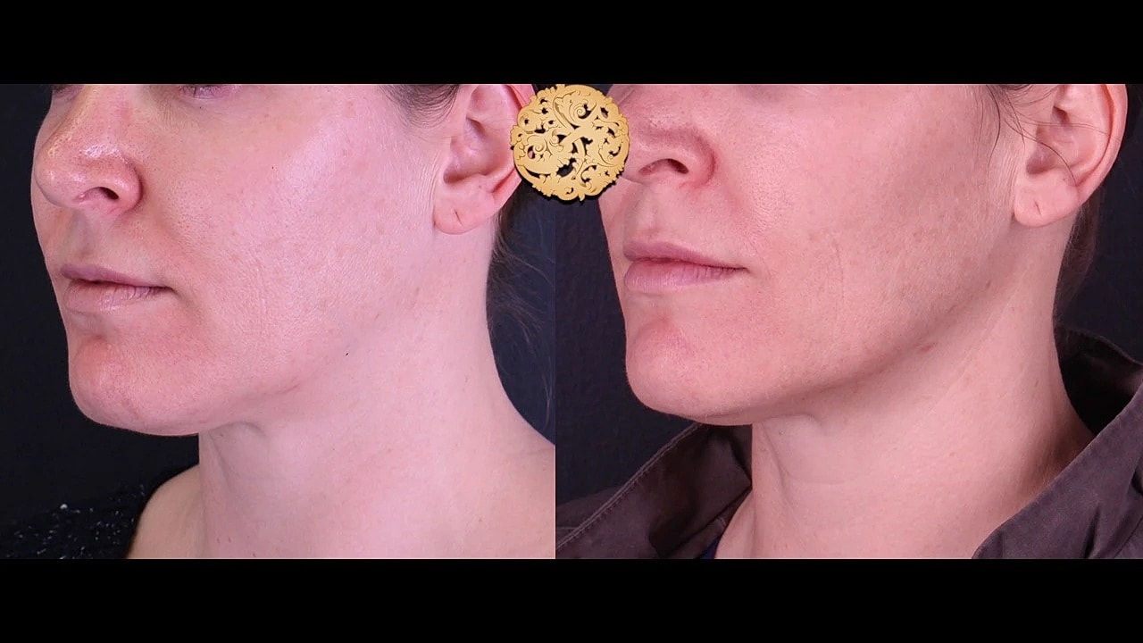 Injectables Gallery Before & After