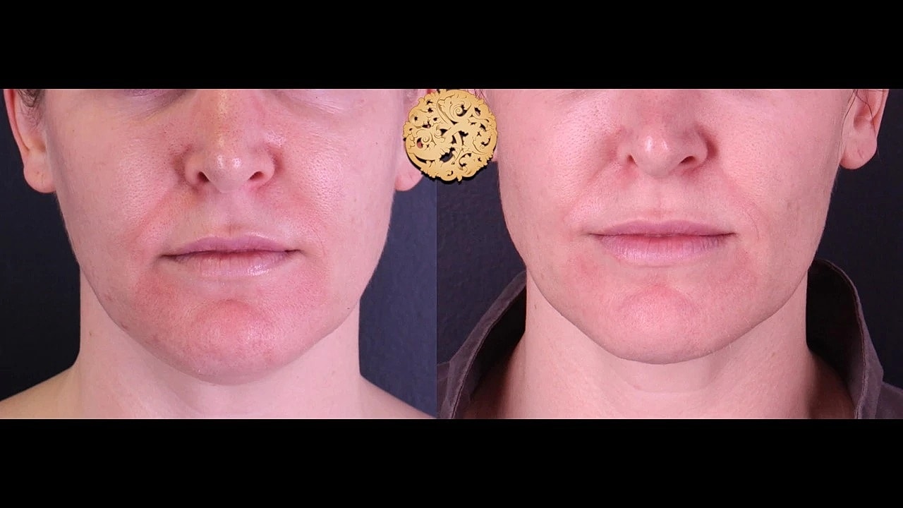 Injectables Gallery Before & After