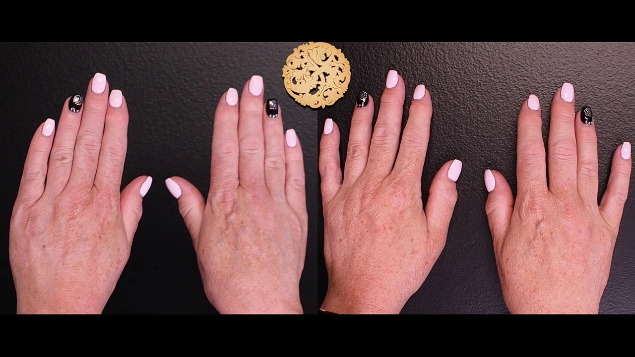 Injectables Gallery Before & After