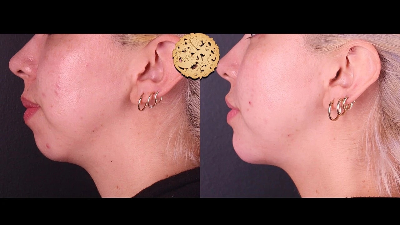 Injectables Gallery Before & After