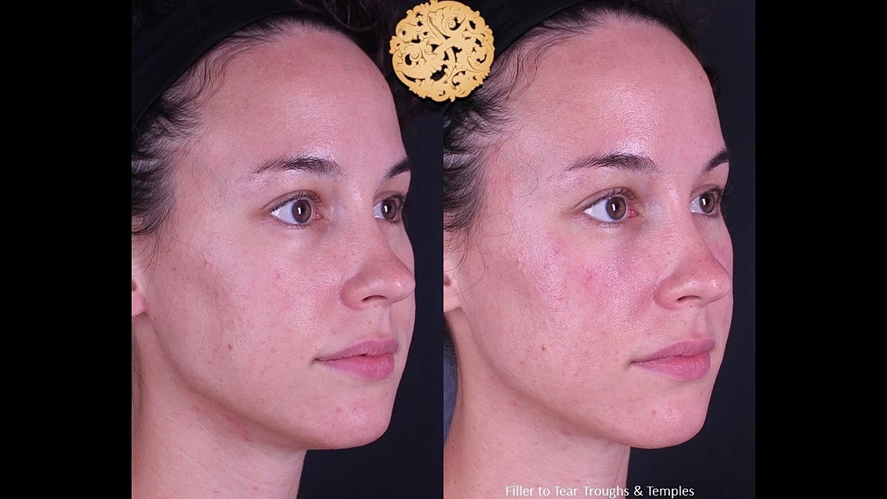 Injectables Gallery Before & After