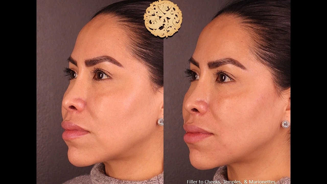 Injectables Gallery Before & After