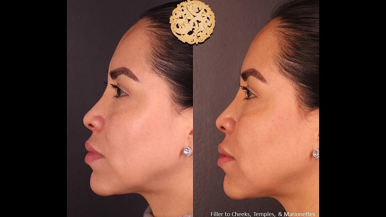 Injectables Gallery Before & After