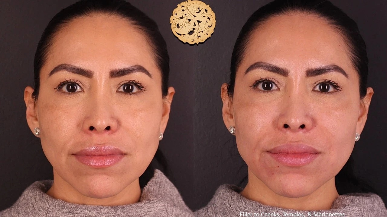 Injectables Gallery Before & After