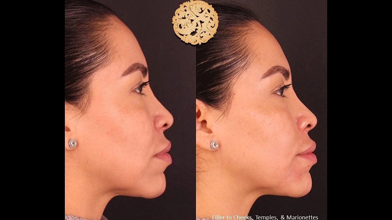 Injectables Gallery Before & After