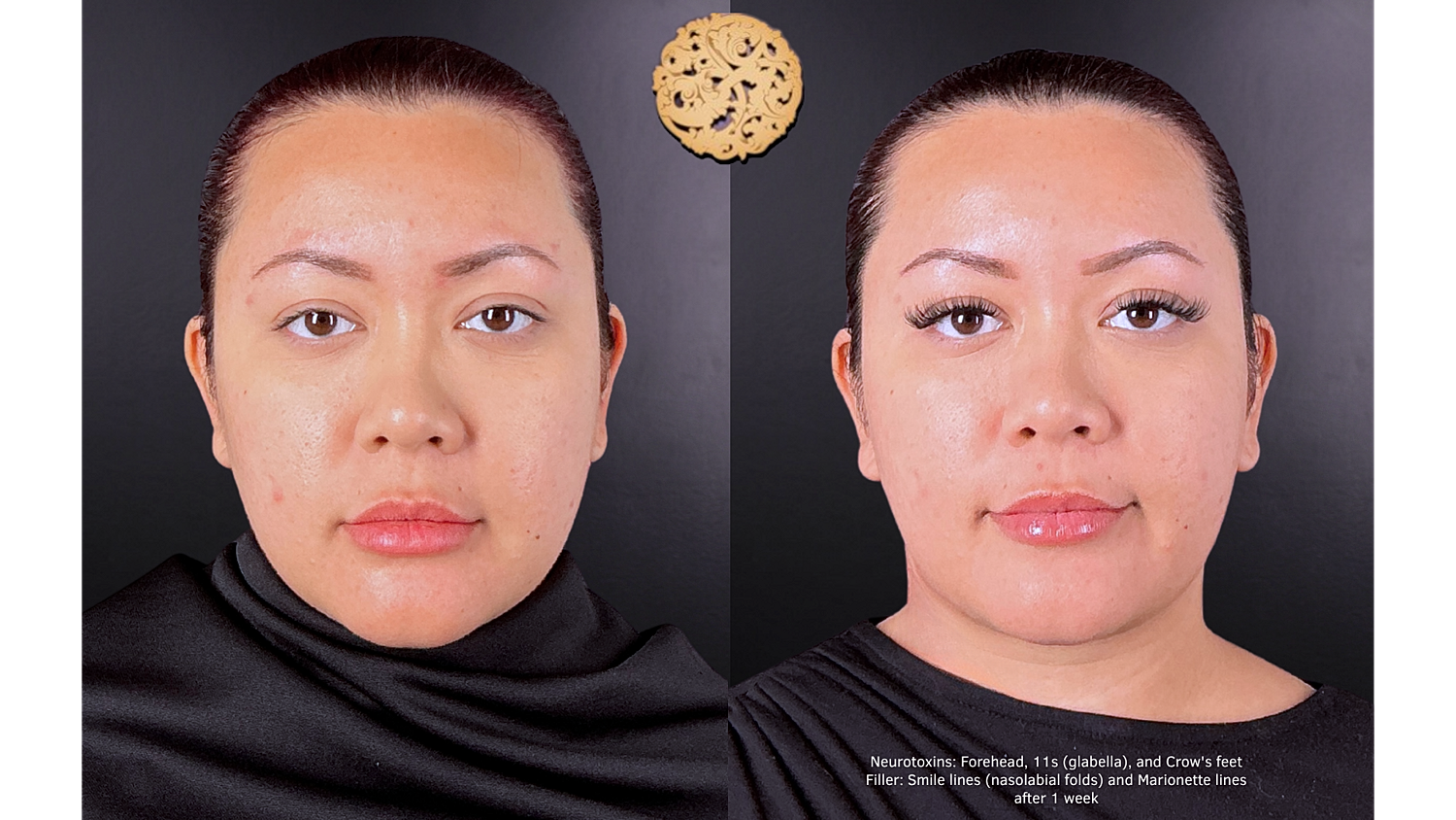 Injectables Gallery Before & After