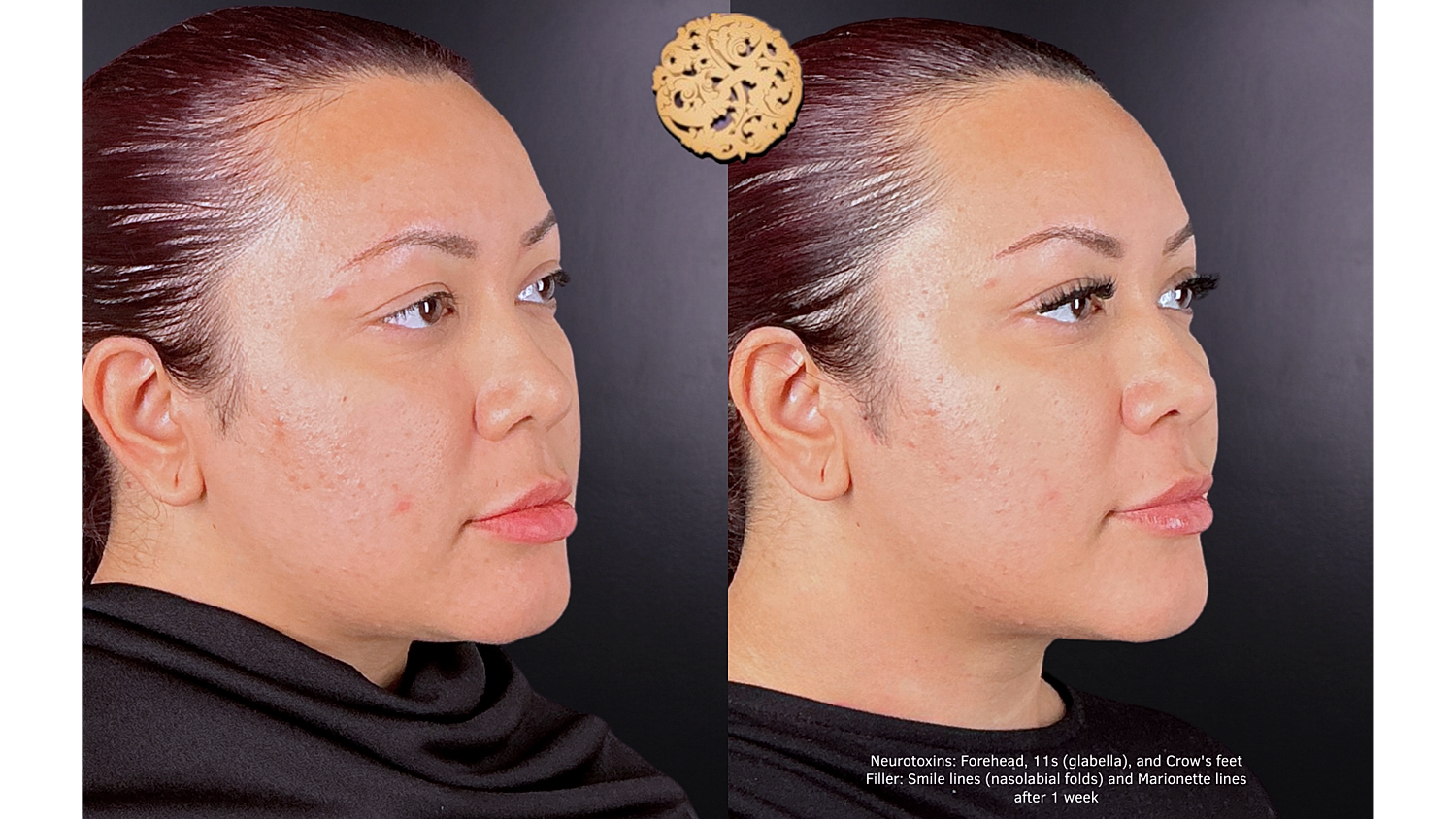 Injectables Gallery Before & After