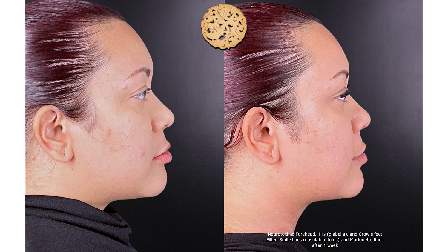 Injectables Gallery Before & After