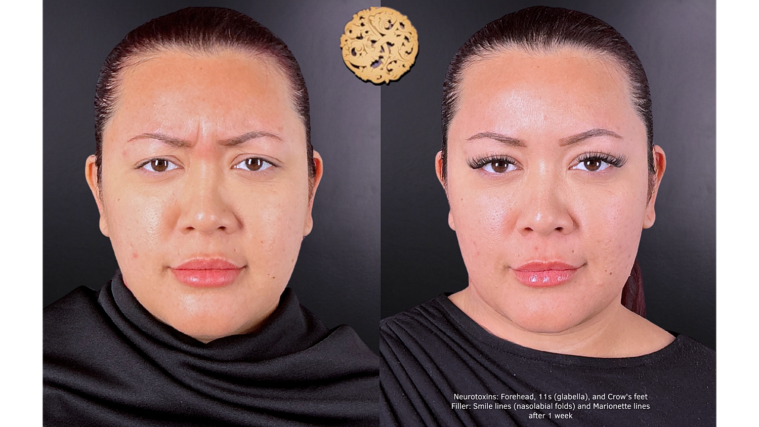 Injectables Gallery Before & After