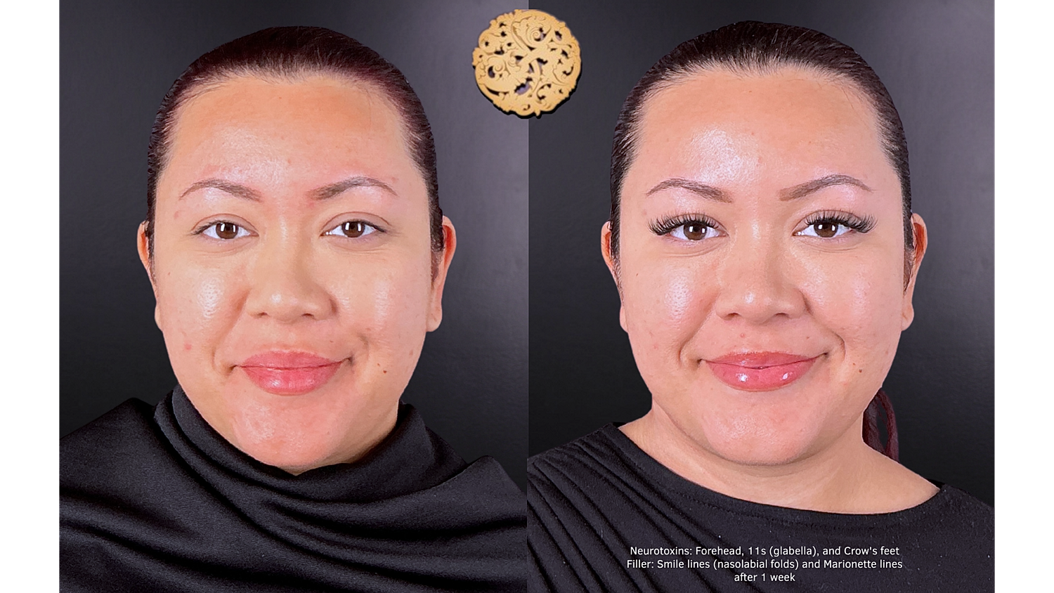 Injectables Gallery Before & After