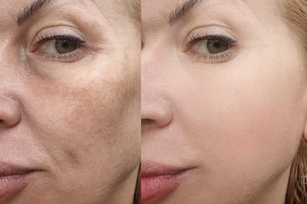 Am I a Good Candidate for Microneedling RF Vivace, Morpheus8